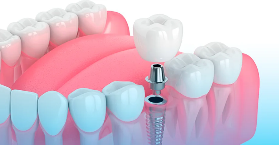 implante dental precio