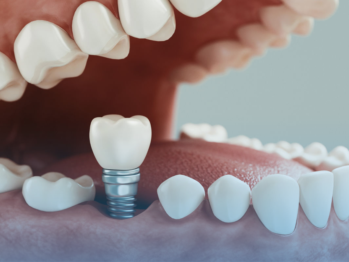 implantes dentales barranquilla