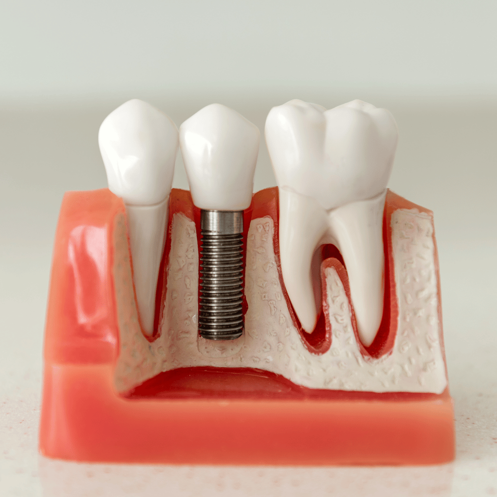 implantes dentales precio