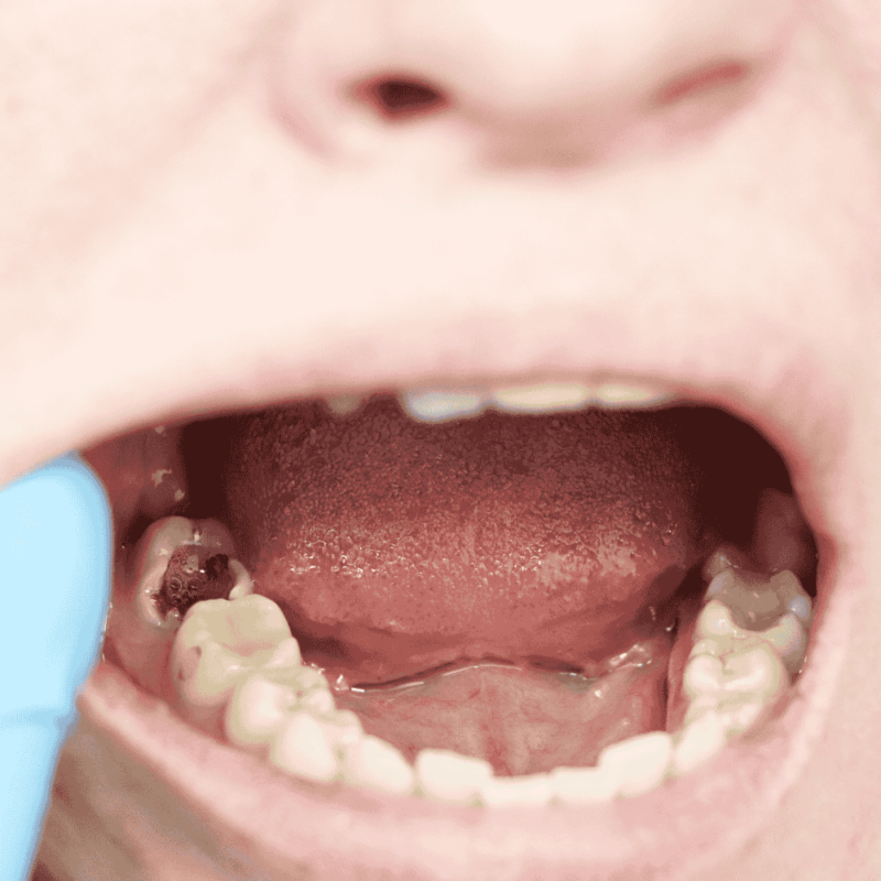 sellantes dentales en la prevención de caries