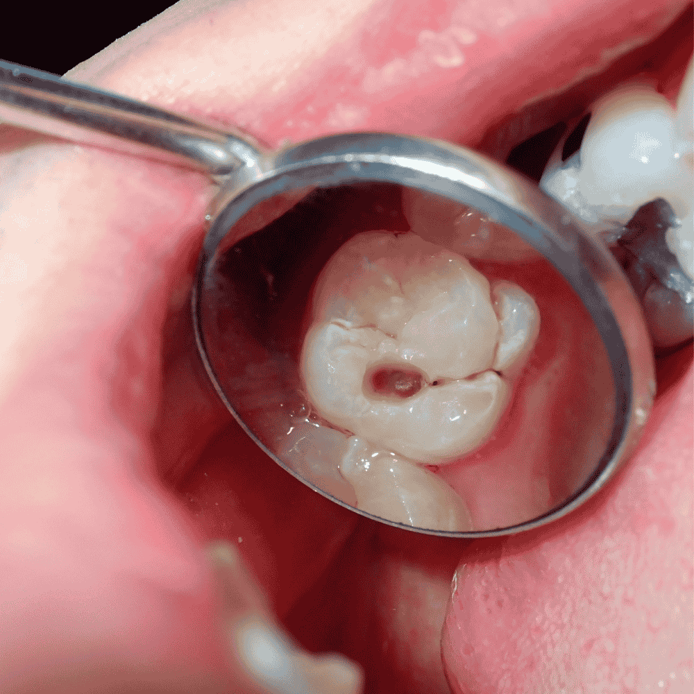 Qué son las caries de la primera infancia y cómo evitarlas