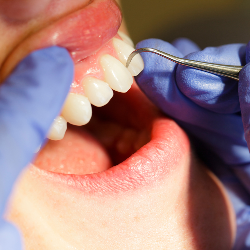 Limpieza dental Barranquila